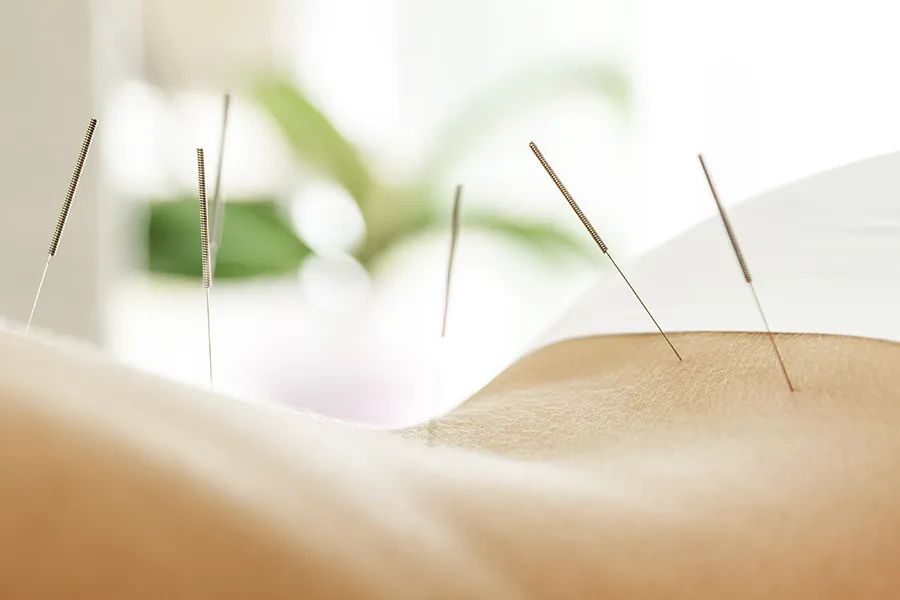 Akupunktur - Hautarztpraxis Dr. Friederike Siebke